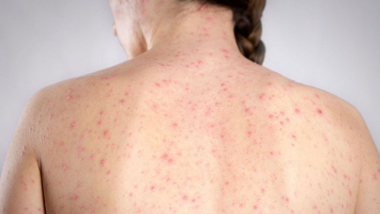 CINCO CASOS DE SARAMPIÓN EN LO QUE VA DEL AÑO EN QUERÉTARO